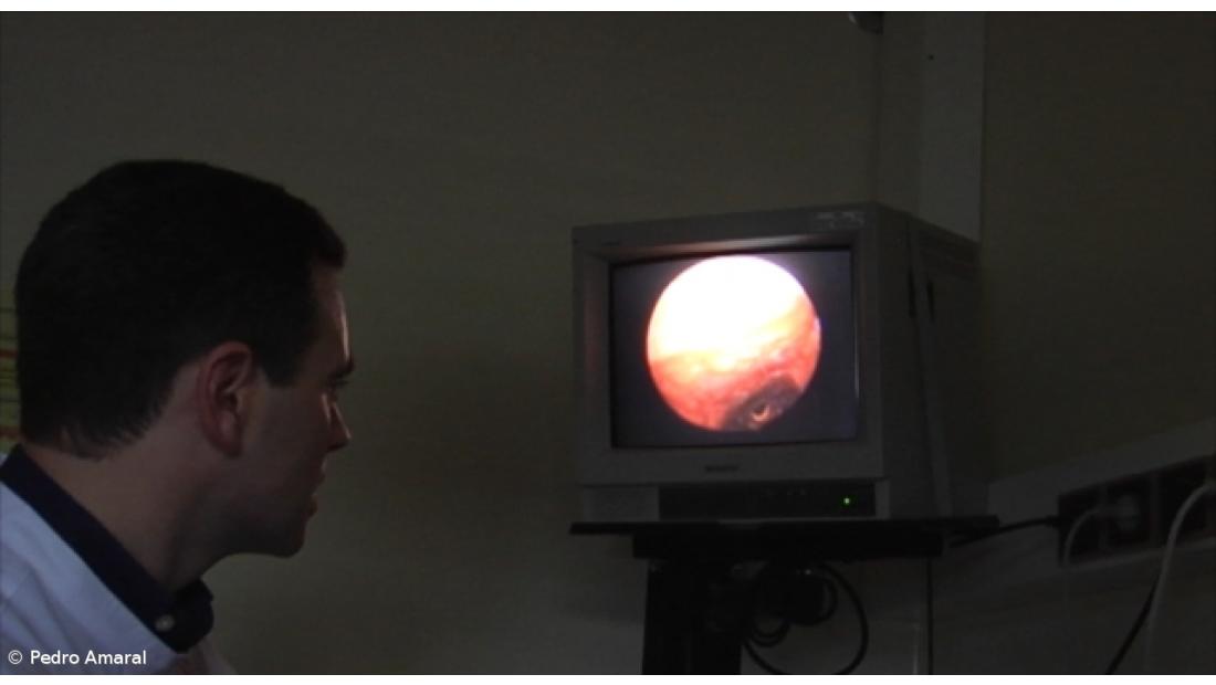 Detetados 130 novos casos por ano de cancro da mama nos Açores após introdução de rastreio