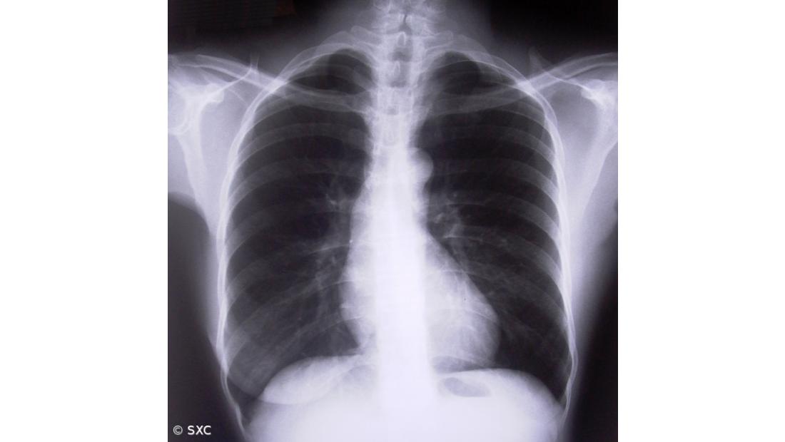 Portugal é o segundo país da UE onde as doenças respiratórias mais matam 
