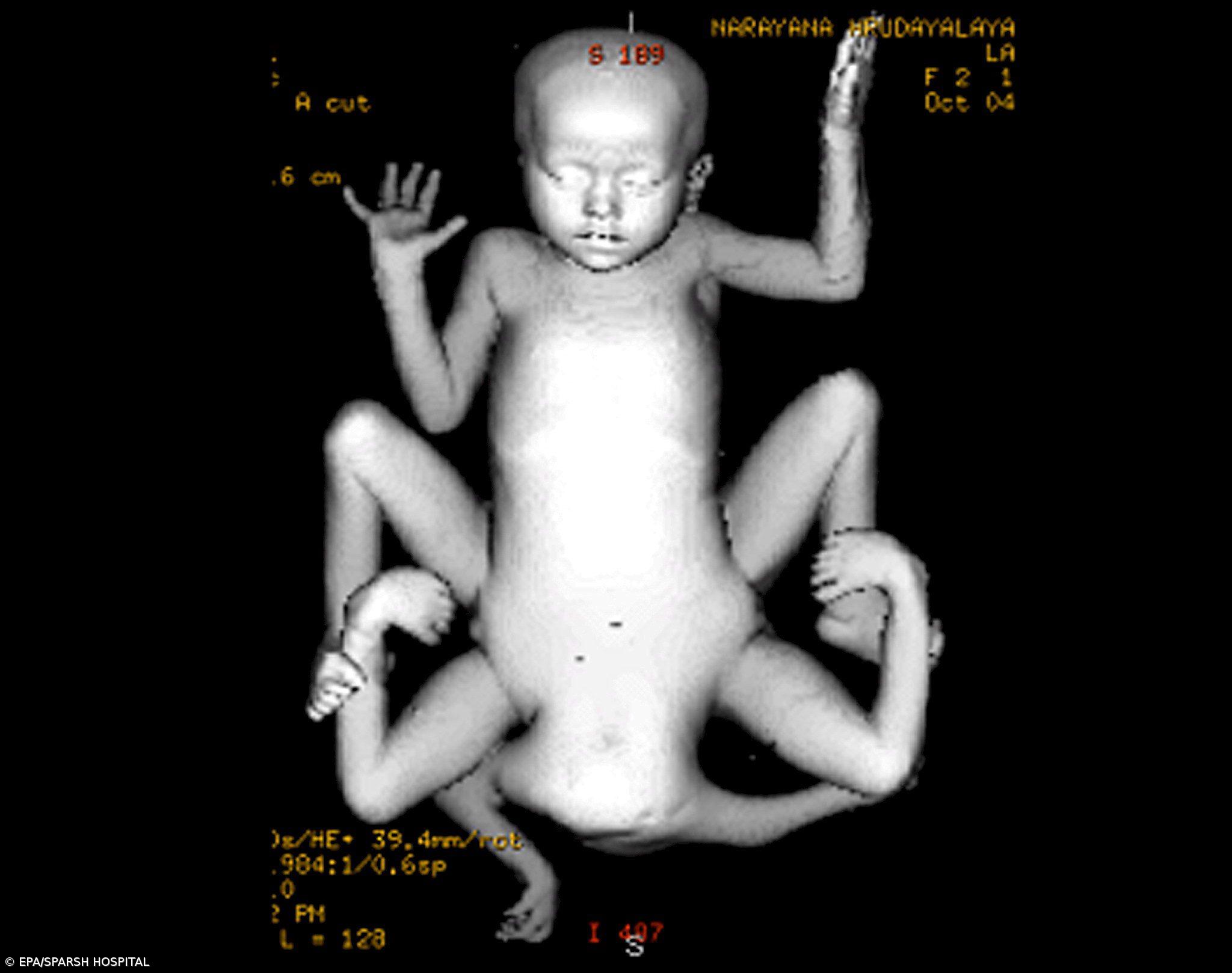 Cirurgiões operam menina com quatro braços e quatro pernas – Imagem 1