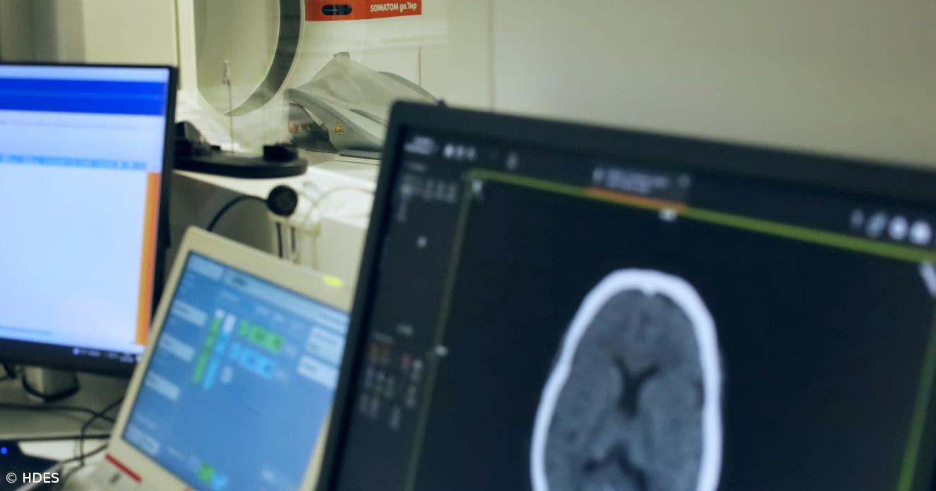 HDES reforça combate ao AVC com tecnologia de IA de última geração